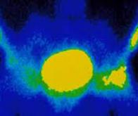 L'ablation focale par des nanoparticules magnétiques contre le cancer de la prostate
