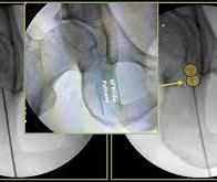 L’ablation par radiofréquence pour lutter contre l'arthrose du genou