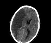 L'accident vasculaire cérébral, une maladie immunologique ?