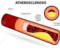 L'athérectomie orbitale pulvérise le calcium dans vos artères…