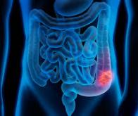Le cancer du côlon serait associé à certaines bactéries