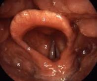 Le larynx artificiel bientôt à l'essai 