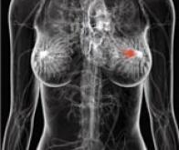 Le nombre de cancers du sein métastasés augmente depuis 30 ans