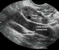 Le risque génétique de cancer de l'ovaire identifié avant la naissance !