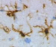 Le rôle des microglies mieux compris dans la maladie d’Alzheimer