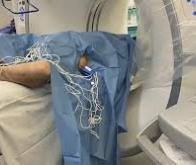 L'électroporation à haute fréquence, une nouvelle arme contre le cancer