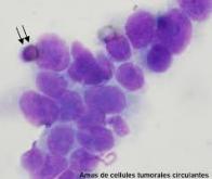 Les cellules tumorales circulantes, biomarqueur de pronostic dans le cancer de la vessie