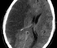 Les conséquences psychologiques de l'AVC sous-estimées