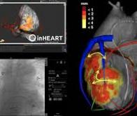 Les jumeaux numériques bouleversent la cardiologie