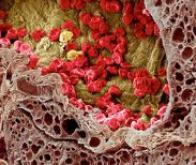 Les nanoparticules rejoignent l'arsenal anti-cancer