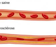 Les traitements biologiques du psoriasis freinent la progression de l’athérosclérose coronarienne