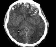 Les traumatismes crâniens augmentent les risques de maladie d'Alzheimer