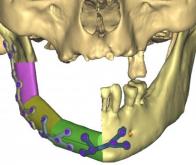 L’impression 3D pour reconstruire la mâchoire