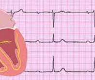 L’Intelligence Artificielle s’impose contre l’arythmie cardiaque…