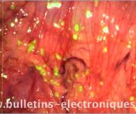 Localisation des cellules tumorales en temps réel par fluorescence