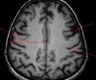 Maladie d'Alzheimer : derrière l'amyloïde, la substance blanche 