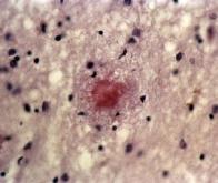 Maladie d'Alzheimer : le rôle des plaques amyloïdes remis en cause