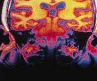 Maladie d'Alzheimer : l'inflammation systémique est liée à un risque accru de démence