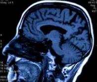 Maladie d'Alzheimer: nouvelles avancées dans la détection précoce