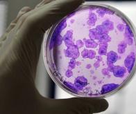 Maladie de Parkinson, la révolution thérapeutique des greffes neuronales