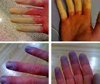 Maladie de Raynaud : découverte de deux gènes impliqués dans cette pathologie douloureuse