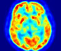 Maladies neurologiques : la stimulation magnétique transcrânienne devient une option thérapeutique