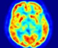 Protéger des effets indésirables de la chimiothérapie contre le cancer du cerveau