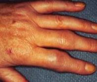Rhumatisme : un nouveau traitement efficace contre l'arthrose des mains