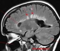 Sclérose en plaques : l’effet neuroprotecteur de la simvastatine se confirme
