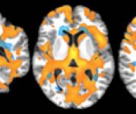 Sclérose en plaques : une accumulation anormale de sodium dans le cerveau mesurée par IRM du sodium ...