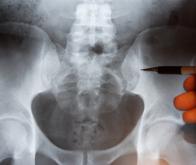 Se casser la hanche quintuple le risque de mortalité chez les femmes