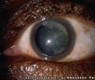 Se faire opérer de la cataracte réduit le risque de démence