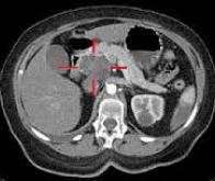 Traitement des cancers de la tête et du cou : la chirurgie pourrait être évitée dans huit cas sur ...