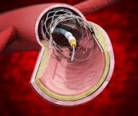 Un cathéter cardiaque non toxique et à la souplesse variable