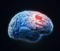 Un implant cérébral pour soigner les TOC