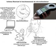 Un microstimulateur contre certaines céphalées