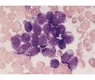 Un nouveau traitement contre la leucémie lymphoblastique aiguë
