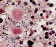 Un nouvel outil pour désactiver les gènes des maladies à prions