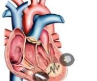 Un pacemaker miniaturisé en 2017