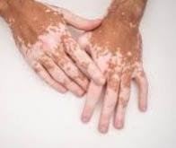 Un premier traitement contre le vitiligo disponible en France