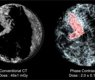 Un scanner à faible rayonnement pour voir le sein en haute définition 