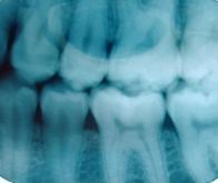 Un traitement révolutionnaire qui fait pousser de nouvelles dents