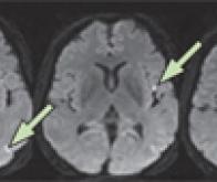 Un vaccin en vue contre la maladie d'Alzheimer 