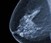 Un vaccin thérapeutique prometteur contre le cancer du sein