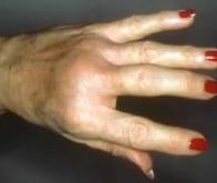 Une avancée thérapeutique majeure contre la polyarthrite rhumatoïde