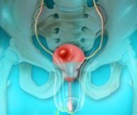 Une BCG thérapie répétée contre le cancer de la vessie
