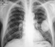 Une nouvelle approche pour traiter les métastases du cancer du poumon