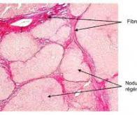 Une nouvelle cible identifiée pour faire régresser la fibrose hépatique