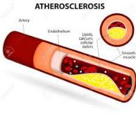 Une nouvelle technique innovante pour vaporiser les plaques d’athérosclérose