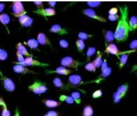 Une protéine commune à l'œuvre dans le cancer du sein et la maladie d'Alzheimer ?